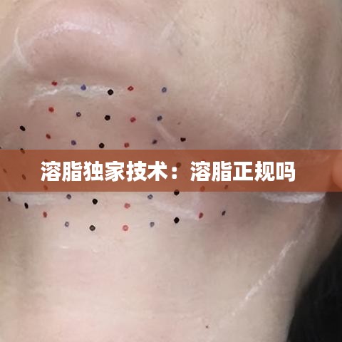 溶脂独家技术：溶脂正规吗 